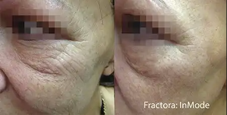 Fractora Before and After